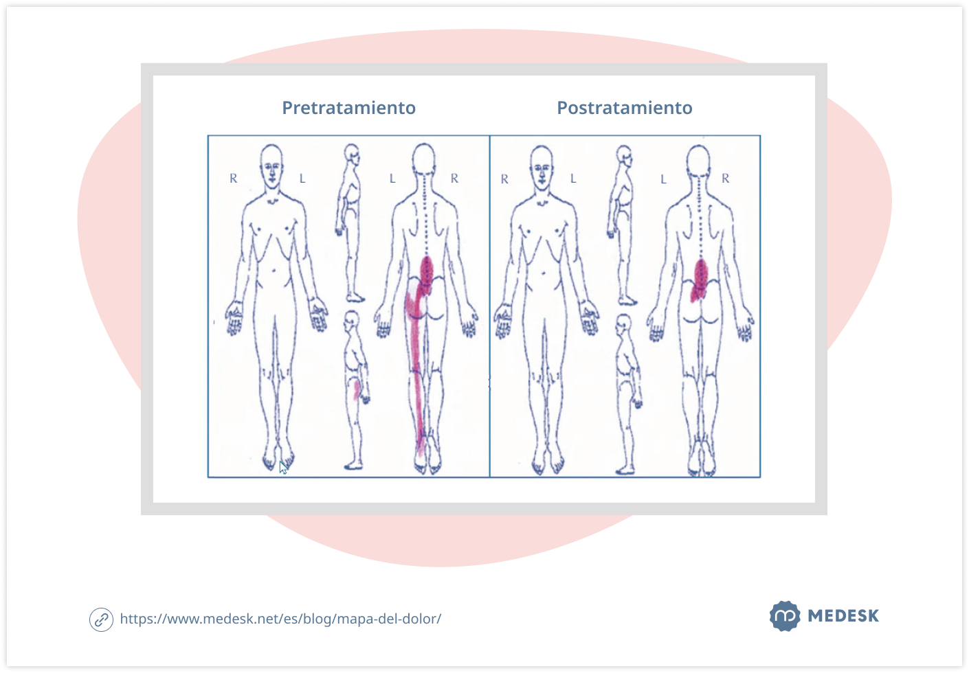 mapa-del-dolor-body-chart-1